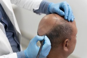 La mejor clínica para el injerto capilar en Don Benito. Solicita tu diagnóstico.