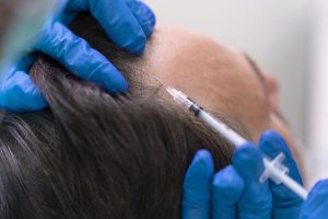 mesoterapia capilar tras un injerto capilar en Badajoz